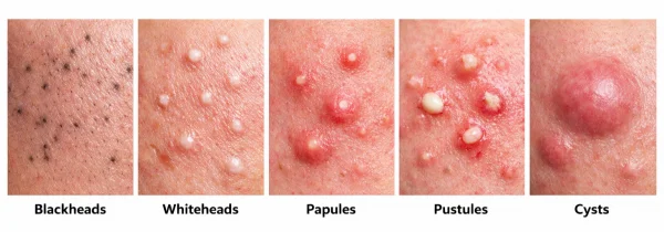 Types of acne: a close-up study