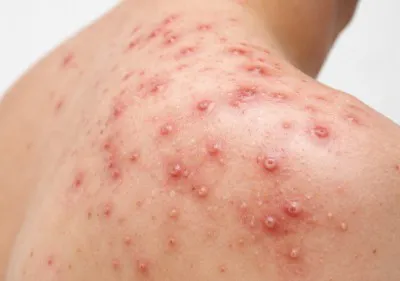 Acne Image