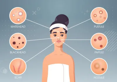 Types of Acne Image