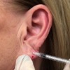 Ear Lobe Rejuvenation