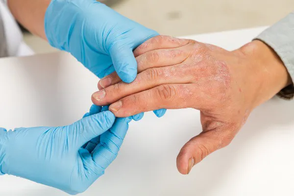 Managing eczema