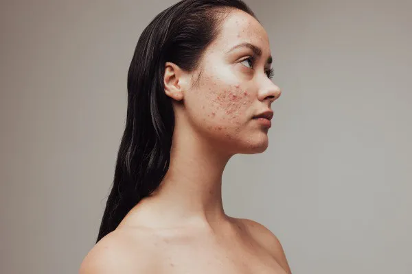 Hormonal Acne