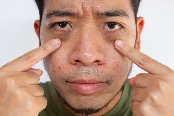 Rejuvenating the Periocular Area