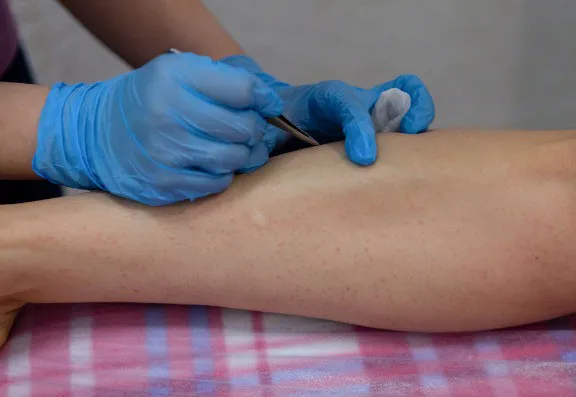 Soprano Laser Hair Removal can reduce ingrown hairs