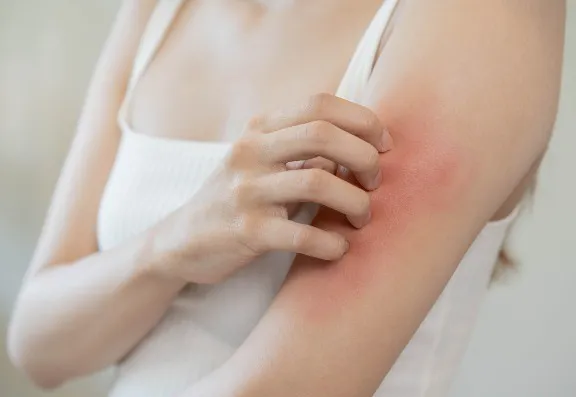 Skin Irritation