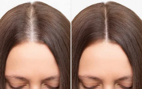 Plinest® Hair?  Image