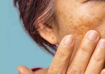 Dermabrasion