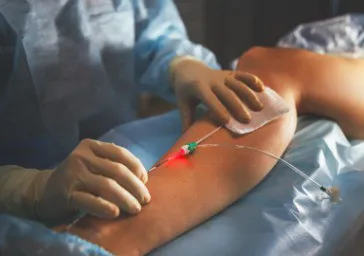 Endovenous Laser Ablation (EVLA/EVLT) clinics