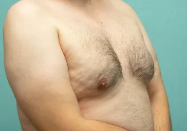 Breast Reduction (Male Gynaecomastia) clinics