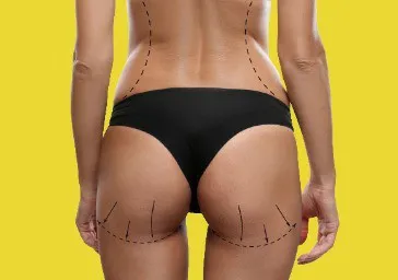 Body Implants (Pectoral, Calf, Buttock)