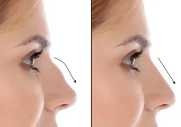 Rhinoplasty clinics