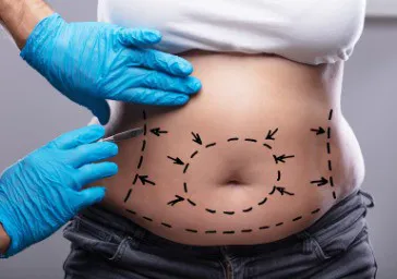 Abdominoplasty (Tummy Tuck) clinics