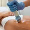 Acoustic Wave Therapy For Cellulite