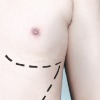 Body Implants (Pectoral, Calf, Buttock)