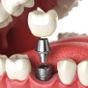 Dental Implants (Teeth)