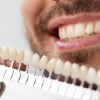 Dental Veneers (Teeth)