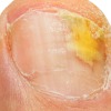 Laser for Fungal Nail Infection (Onychomycosis)