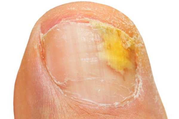 Laser for Fungal Nail Infection (Onychomycosis) Image