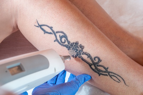 Laser Tattoo Removal Information Image
