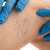 Sclerotherapy and Microsclerotherapy