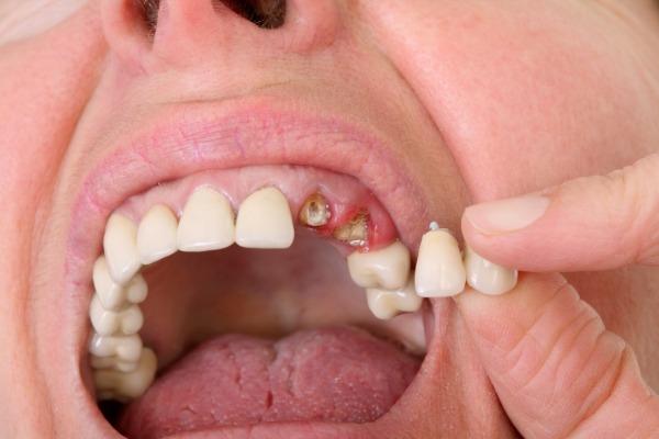 Teeth Cosmetic Correction (Fillings, Bonding, Crowns & Bridges) Information Image