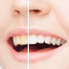 Teeth Whitening or Bleaching