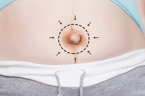 Umbilicoplasty or Navel, Belly Button Surgery