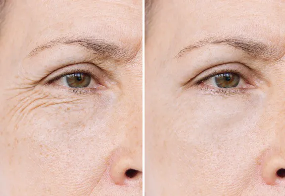 Fine lines and wrinkle reduction 