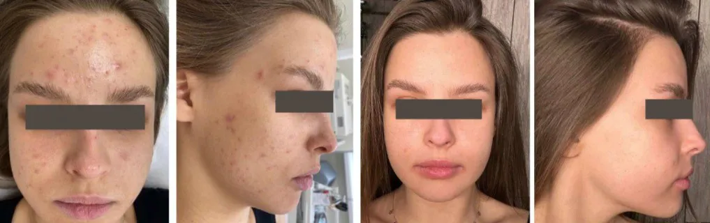 Acne Before and after images Acne Before and after images