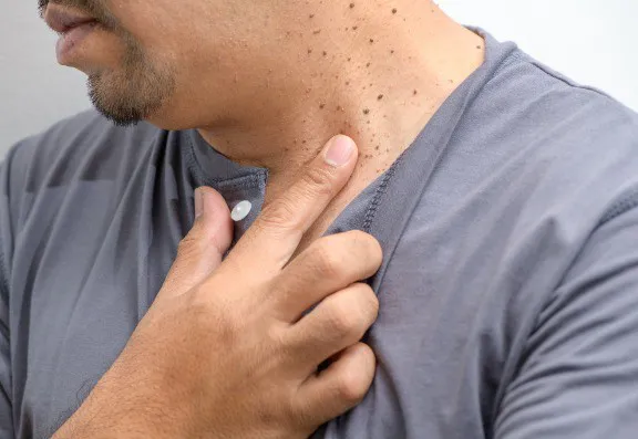 Not Yet Using Fractional Plasma Technology for Skin Tag Removal? It May Be Worth Considering