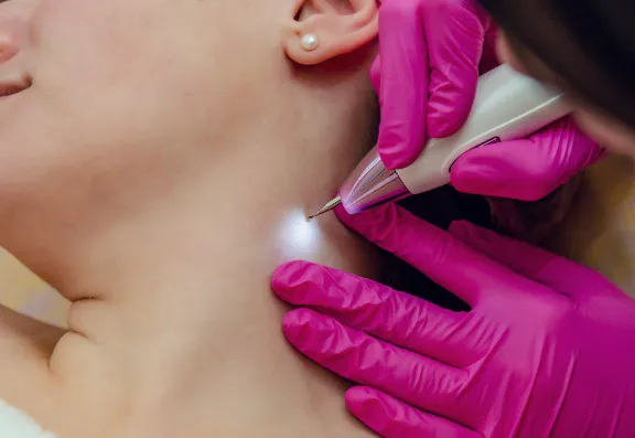 Why Skin Tag Removal Is Worth Prioritising as a Core Offering