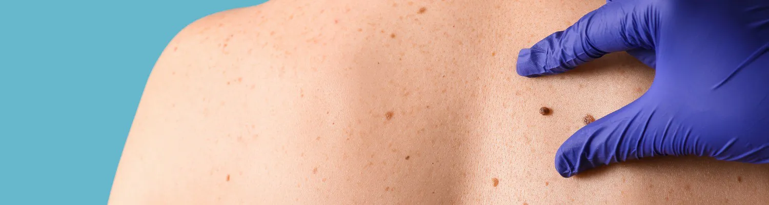 Bridging the Gap: Dr. Toby Nelson’s Mission to Ease NHS Burdens with Map My Mole