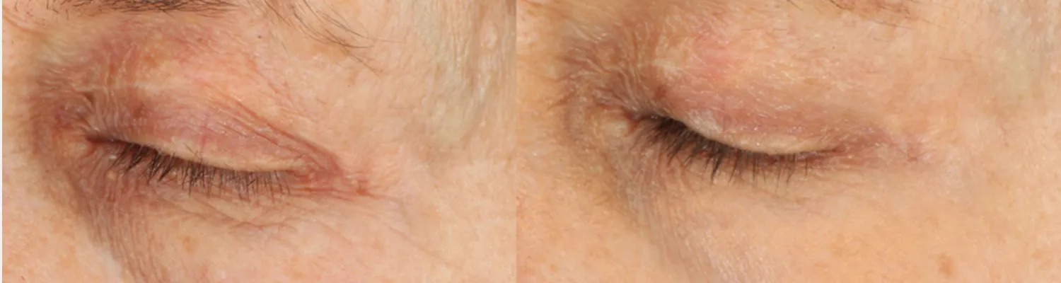 Discover Tixel: The Innovative Skin-Resurfacing Treatment 