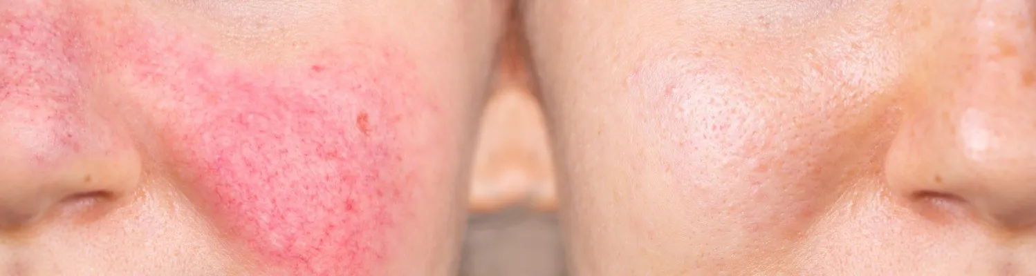 How to Treat Facial Spider Veins by Short Wave Diathermy
