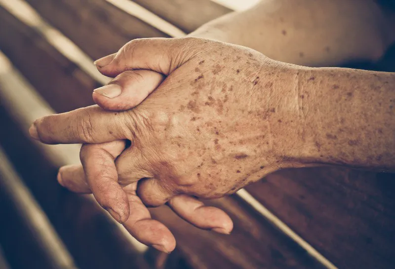 Advancing Hand Rejuvenation with Newest® 