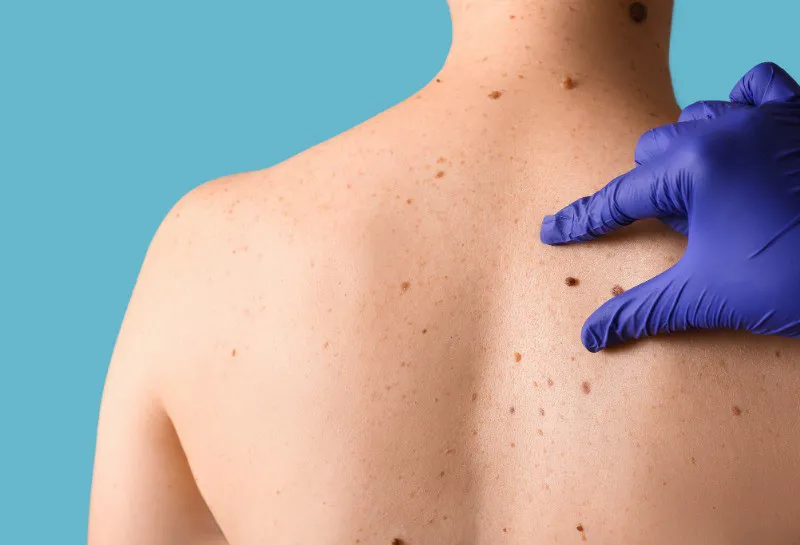 Bridging the Gap: Dr. Toby Nelson’s Mission to Ease NHS Burdens with Map My Mole