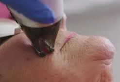 Clinic Study: Thermomechanical Ablation: A Safer Way to Rejuvenate Skin?