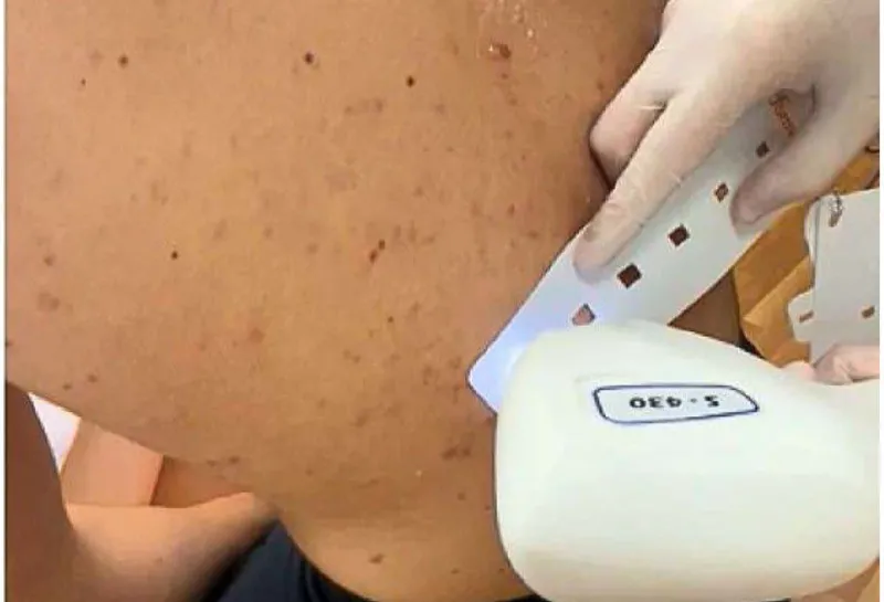 Exploring 3D IPL for Early Acne Intervention and Scar Prevention