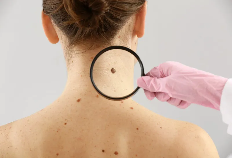 How to Spot a Melanoma