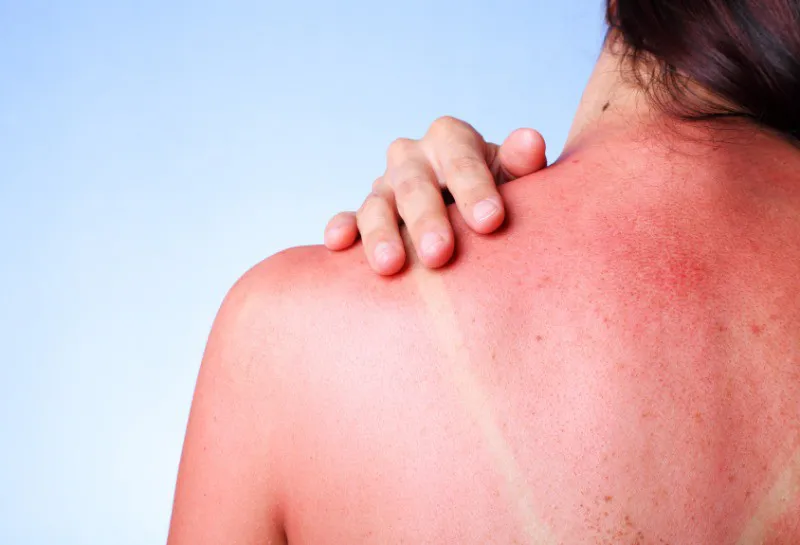 More Than Half of Brits Get Sunburnt Accidentally