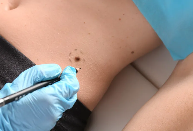 What is Teledermatology?