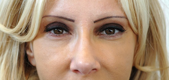 Revanesse Female Facial Makeover After Image