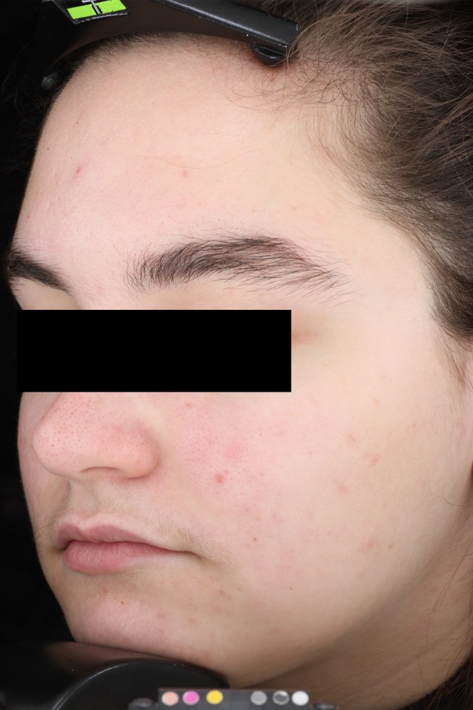 AlumierMD After Treatment