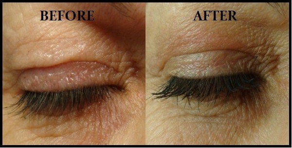 Plexr Plasma Soft Surgery, Non-Surgical Blepharoplasty Information