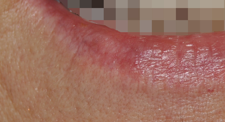 Venous Lake in lip removed by laser treatment