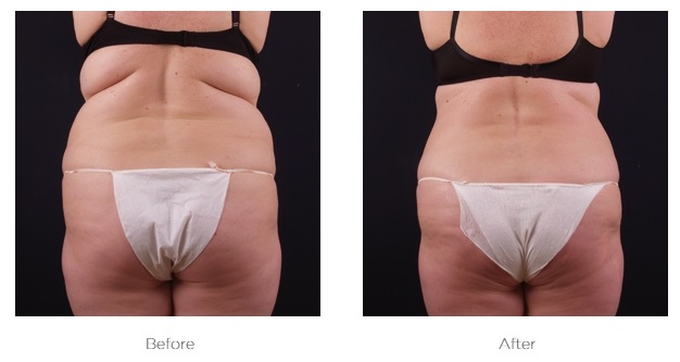 Exilis_Before_and_AFter_Abdomen