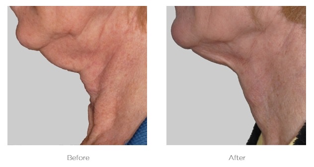 Exilis_Before_and_After_Chin