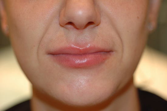 Lips After Revanesse Image