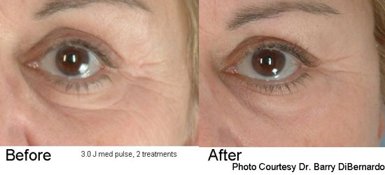Before and After two treatments with the Pearl YSGG Laser