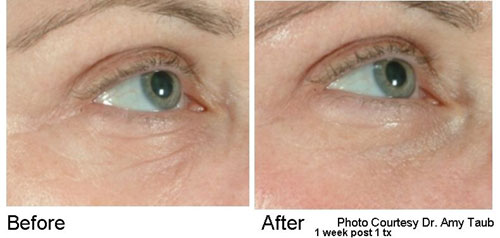 Before and After one treatment with the Pearl YSGG Laser